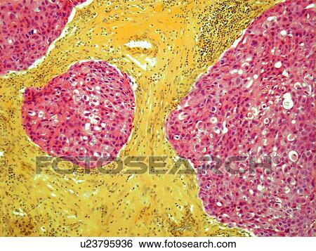 Breast cancer, light micrograph View Large Illustration Stock Illustration - Breast cancer, light micrograph. Fotosearch
