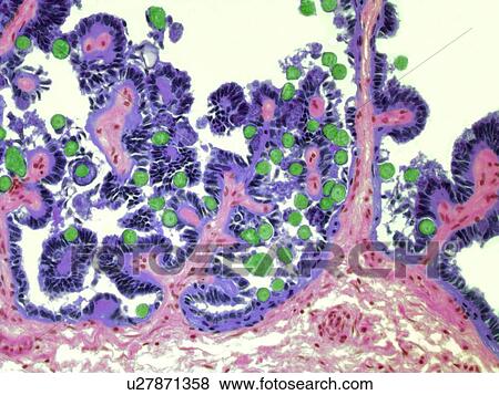 Stock Illustration - Coccidiosis, light micrograph. Fotosearch