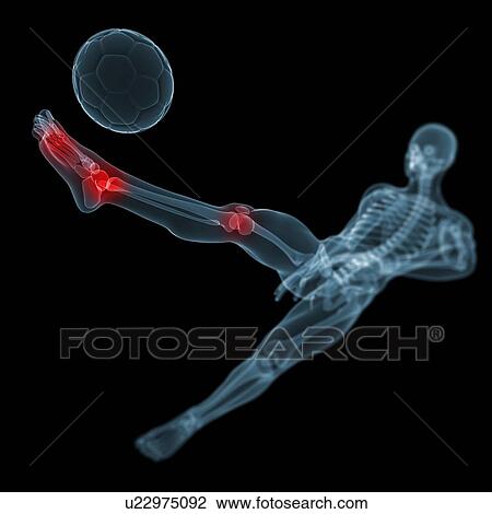 Football injury, artwork View Large Illustration Drawing - Football injury, artwork. Fotosearch