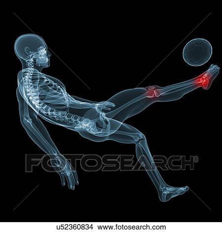 Stock Illustration - Football injury, artwork. Fotosearch