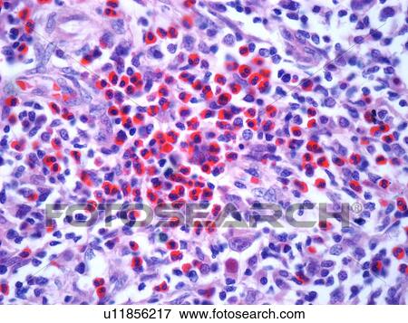 Hodgkin's lymphoma, light micrograph View Large Illustration Stock Illustration - Hodgkin's lymphoma, light micrograph. Fotosearch