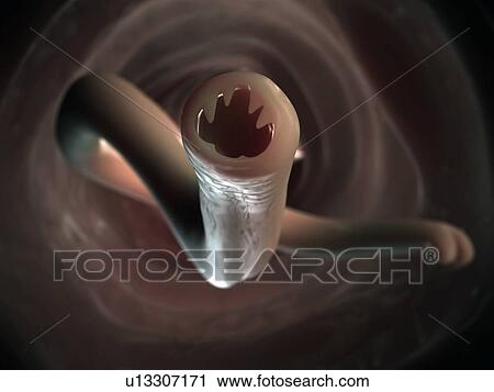 Clip Art - Hookworm, artwork. Fotosearch