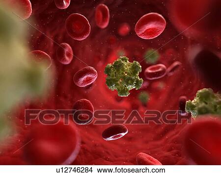 Stock Illustration - HPV infection, artwork. Fotosearch