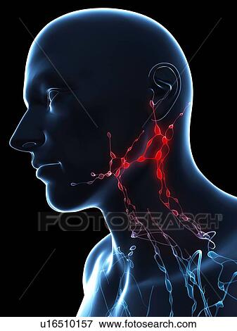 Inflamed lymph nodes, conceptual artwork View Large Illustration Stock Illustration - Inflamed lymph nodes, conceptual artwork. Fotosearch