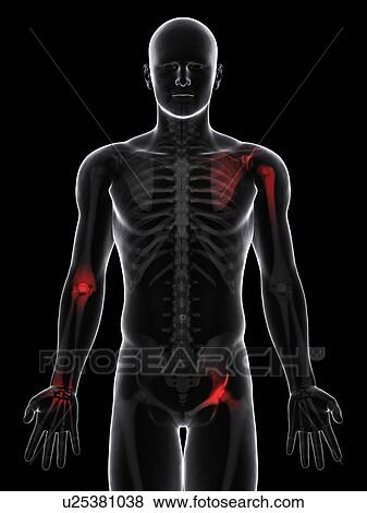 Joint pain, conceptual artwork View Large Illustration Stock Illustration - Joint pain, conceptual artwork. Fotosearch