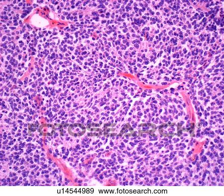 Stock Illustration - Kidney cancer, light micrograph. Fotosearch