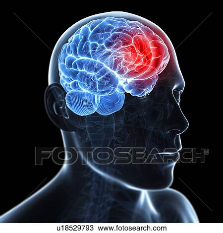 Drawing - Migraine, conceptual artwork. Fotosearch