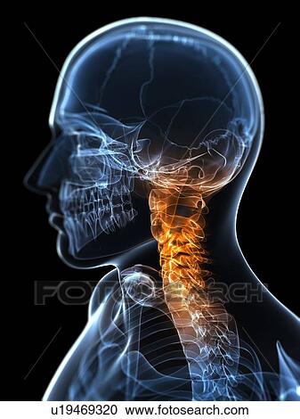 Clipart - Neck pain, conceptual artwork. Fotosearch