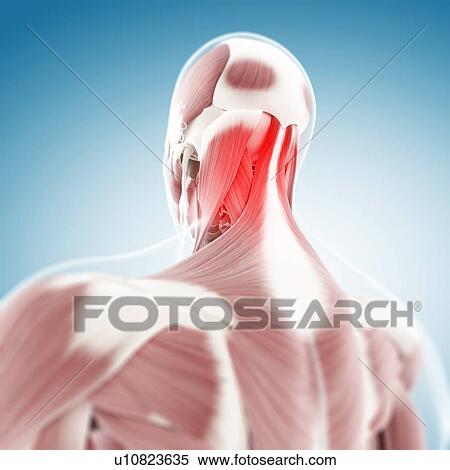 Stock Illustration - Neck pain, conceptual artwork. Fotosearch