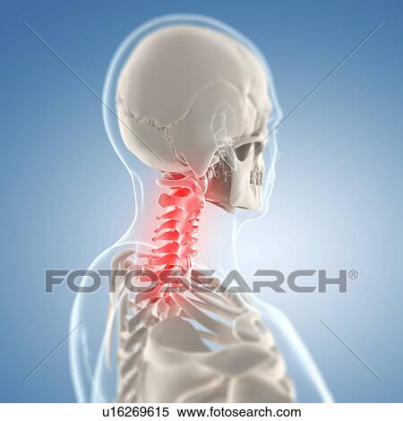 Stock Illustration - Neck pain, conceptual artwork. Fotosearch