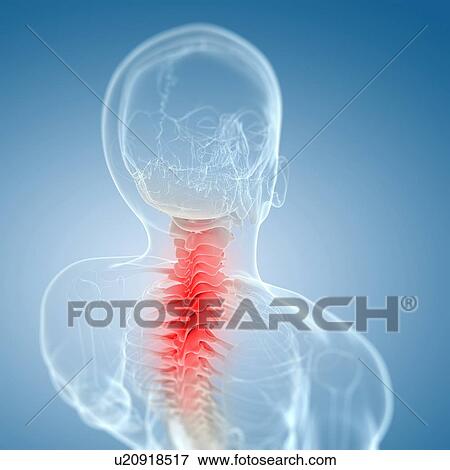 Stock Illustration - Neck pain, conceptual artwork. Fotosearch