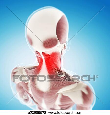 Neck pain, conceptual artwork View Large Illustration Stock Illustration - Neck pain, conceptual artwork. Fotosearch