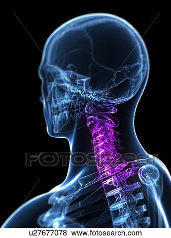 Neck pain, conceptual artwork View Large Illustration Stock Illustration - Neck pain, conceptual artwork. Fotosearch
