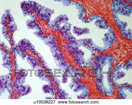 Stock Illustration - Prostate cancer, light micrograph. Fotosearch