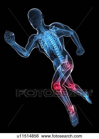 Stock Illustration - Running injuries, conceptual artwork. Fotosearch