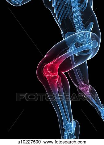 Clipart - Running injury, conceptual artwork. Fotosearch