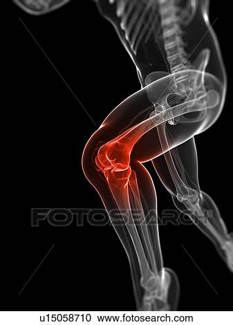 Clipart - Running injury, conceptual artwork. Fotosearch
