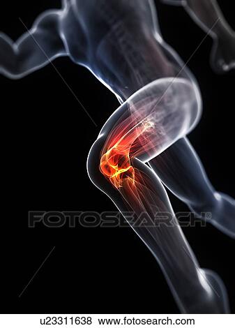 Running injury, conceptual artwork View Large Illustration Stock Illustration - Running injury, conceptual artwork. Fotosearch