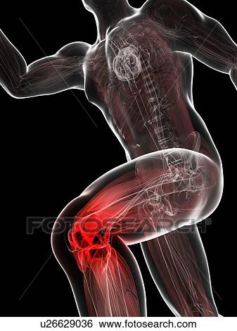 Running injury, conceptual artwork View Large Illustration Stock Illustration - Running injury, conceptual artwork. Fotosearch