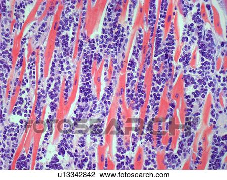 Secondary heart cancer, light micrograph View Large Illustration Drawing - Secondary heart cancer, light micrograph. Fotosearch