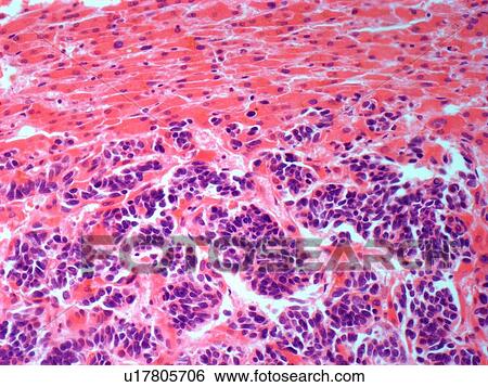 Stock Illustration - Secondary liver cancer, light micrograph. Fotosearch