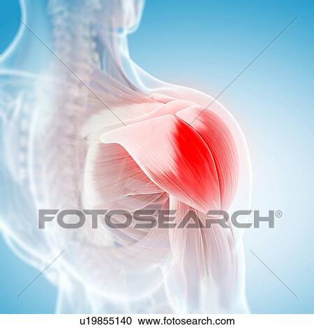 Shoulder pain, conceptual artwork View Large Illustration Clipart - Shoulder pain, conceptual artwork. Fotosearch