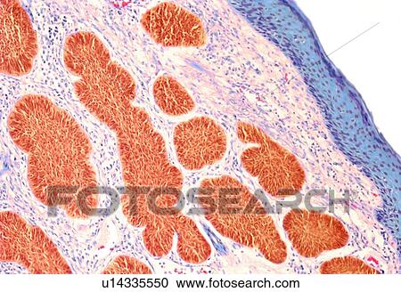 Clipart - Skin cancer, light micrograph. Fotosearch