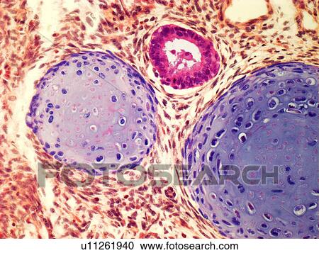 Clipart - Testicular cancer, light micrograph. Fotosearch