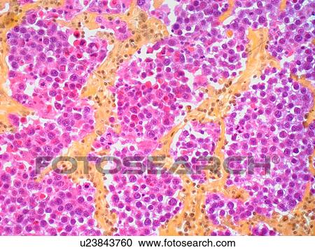 Testicular cancer, light micrograph View Large Illustration Clipart - Testicular cancer, light micrograph. Fotosearch