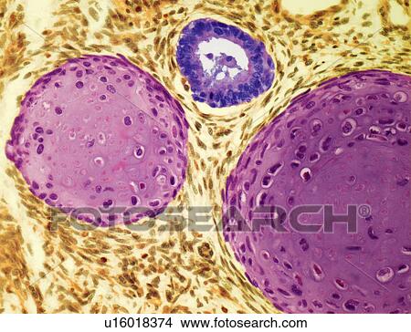 Stock Illustration - Testicular cancer, light micrograph. Fotosearch