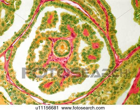Thyroid cancer, light micrograph View Large Illustration Clip Art - Thyroid cancer, light micrograph. Fotosearch