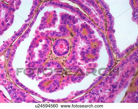 Thyroid cancer, light micrograph View Large Illustration Clipart - Thyroid cancer, light micrograph. Fotosearch