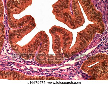 Stock Illustration - Uterine cancer, light micrograph. Fotosearch