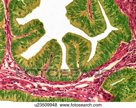 Stock Illustration - Uterine cancer, light micrograph. Fotosearch
