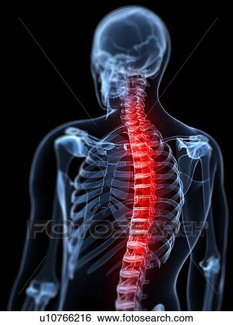 Back pain, conceptual artwork View Large Illustration Stock Illustration - Back pain, conceptual artwork. Fotosearch