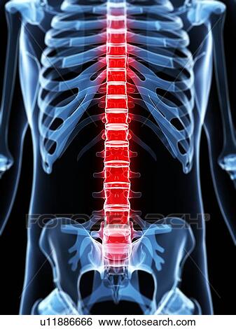 Back pain, conceptual artwork View Large Illustration Stock Illustration - Back pain, conceptual artwork. Fotosearch