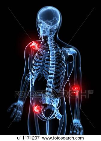 Joint pain, conceptual artwork View Large Illustration Stock Illustration - Joint pain, conceptual artwork. Fotosearch