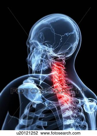 Neck pain, conceptual artwork View Large Illustration Drawing - Neck pain, conceptual artwork. Fotosearch