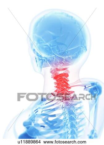 Stock Illustration - Neck pain, conceptual artwork. Fotosearch