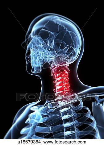 Stock Illustration - Neck pain, conceptual artwork. Fotosearch