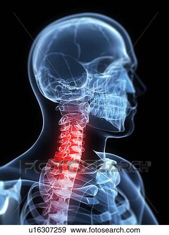 Neck pain, conceptual artwork View Large Illustration Stock Illustration - Neck pain, conceptual artwork. Fotosearch