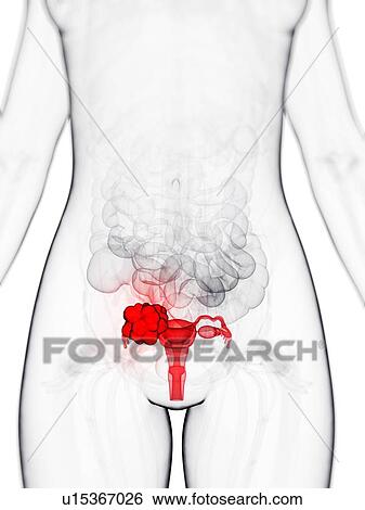 Ovarian cancer, artwork View Large Illustration Stock Illustration - Ovarian cancer, artwork. Fotosearch