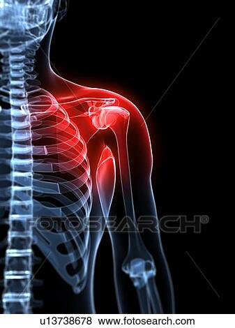 Shoulder pain, conceptual artwork View Large Illustration Stock Illustration - Shoulder pain, conceptual artwork. Fotosearch