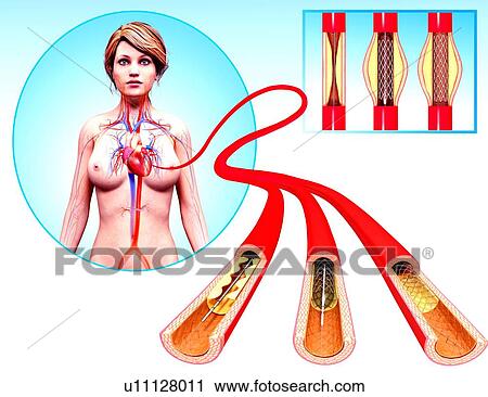 Angioplasty, artwork View Large Illustration Clip Art - Angioplasty, artwork. Fotosearch