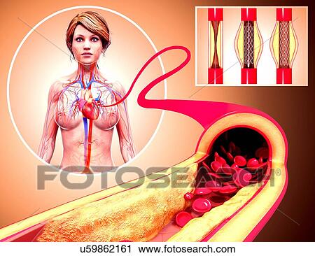 Angioplasty, artwork View Large Illustration Clip Art - Angioplasty, artwork. Fotosearch