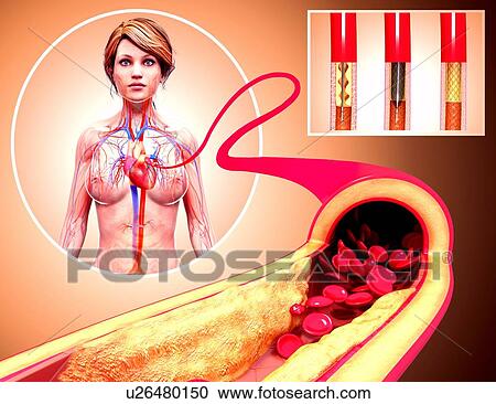 Angioplasty, artwork View Large Illustration Clipart - Angioplasty, artwork. Fotosearch