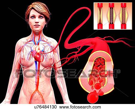 Angioplasty, artwork View Large Illustration Clipart - Angioplasty, artwork. Fotosearch