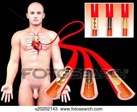 Angioplasty, artwork View Large Illustration Drawing - Angioplasty, artwork. Fotosearch