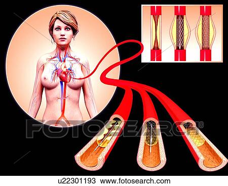 Angioplasty, artwork View Large Illustration Drawing - Angioplasty, artwork. Fotosearch