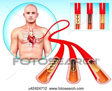 Angioplasty, artwork View Large Illustration Drawing - Angioplasty, artwork. Fotosearch
